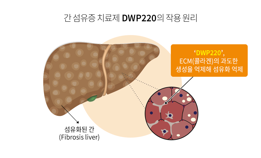 대웅제약, 중증 간 섬유증 '경구용 신약' 세계 최초 개발 추진